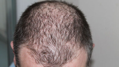 Alopecia