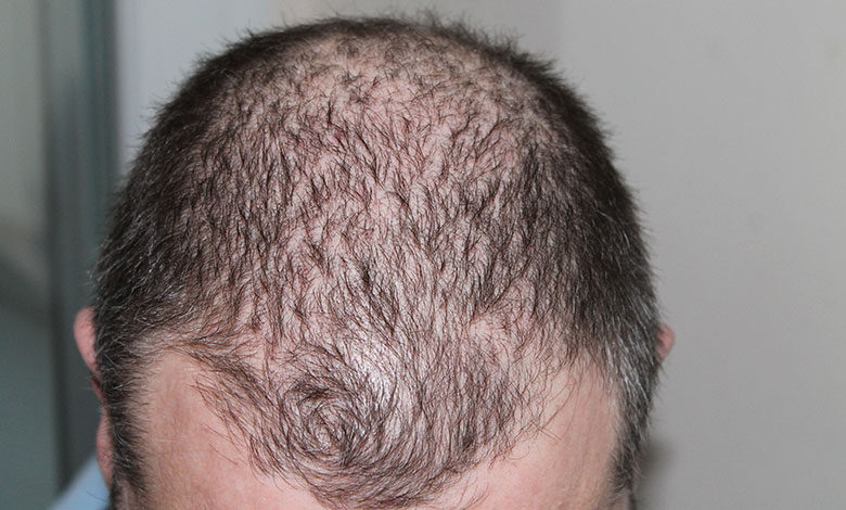 Alopecia