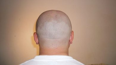 Alopecia