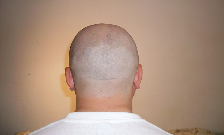 Alopecia