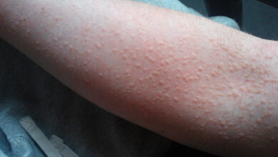 Urticaria