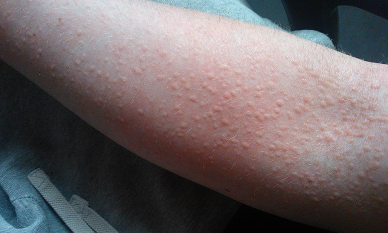 Urticaria