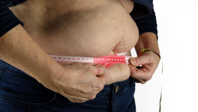Obesity
